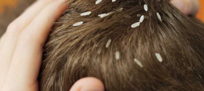 روش های درمان شپش موی سر