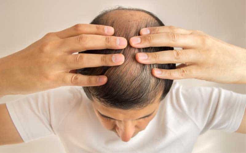 کنترل ریزش موی مردانه