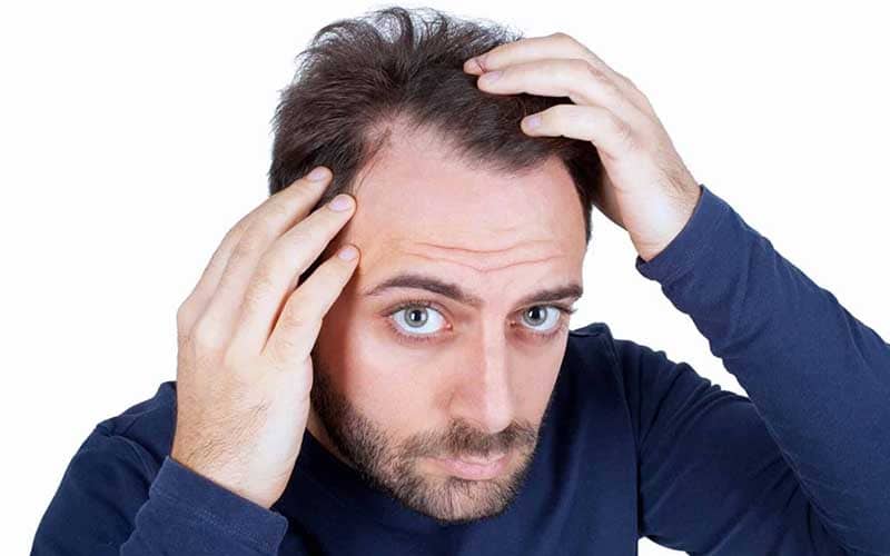 کنترل ریزش موی مردانه