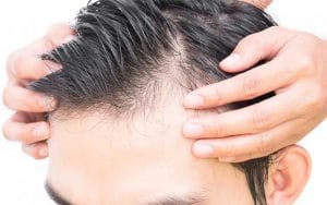 کنترل ریزش موی مردانه