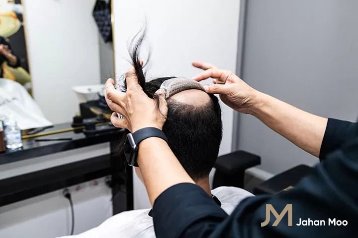 پروتز مو چیست؟ چه تفاوتی با کلاه گیس و کاشت مو دارد؟