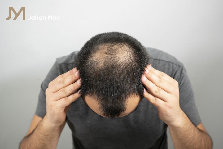 نکات اساسی در کنترل ریزش مو