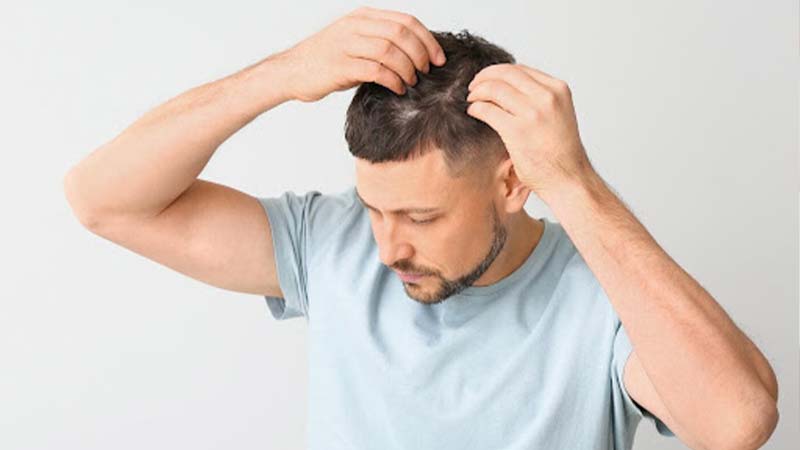 بهترین روش‌های جلوگیری از ریزش مو در آقایان