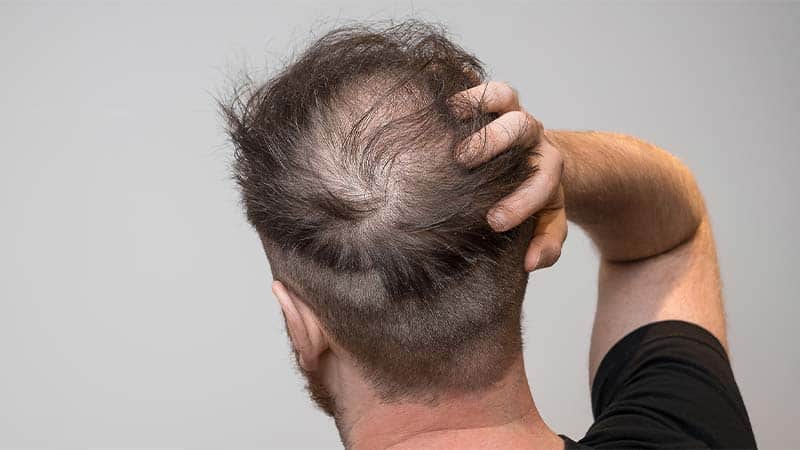 تغییر سبک زندگی برای کاهش ریزش مو